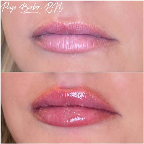 Lip Augmentation Before & After Photos by Flawless Medspa in Las Vegas NV