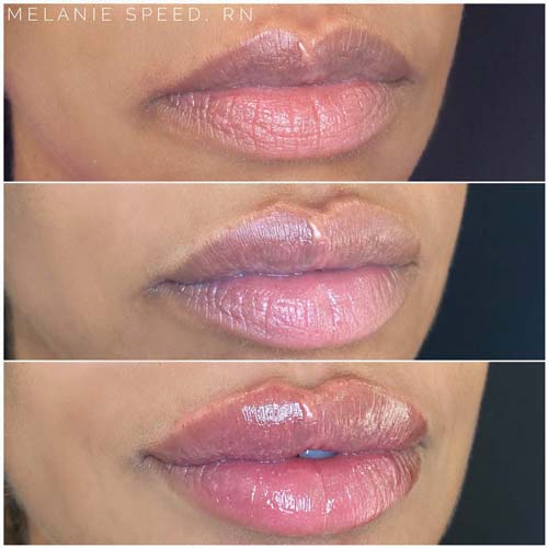 Lip Augmentation Before & After Photos by Flawless Medspa in Las Vegas NV