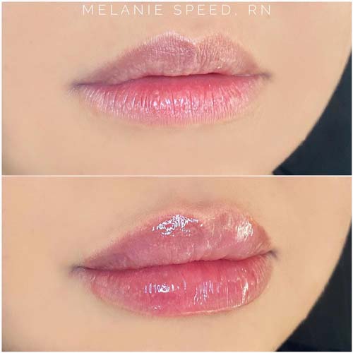 Lip Augmentation Before & After Photos by Flawless Medspa in Las Vegas NV