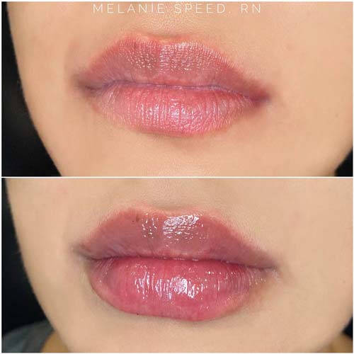 Lip Augmentation Before & After Photos by Flawless Medspa in Las Vegas NV