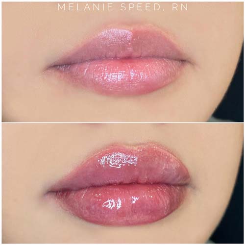 Lip Augmentation Before & After Photos by Flawless Medspa in Las Vegas NV