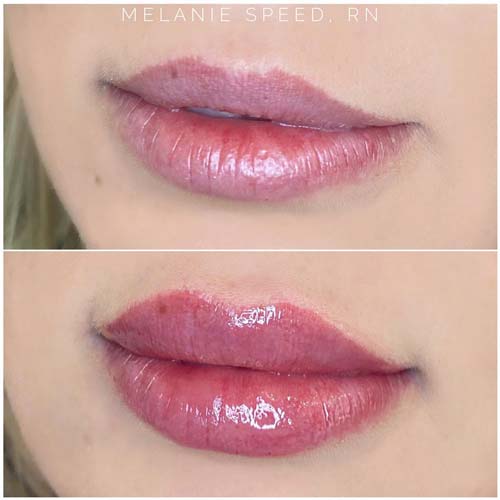 Lip Augmentation Before & After Photos by Flawless Medspa in Las Vegas NV