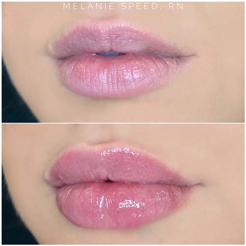 Lip Augmentation Before & After Photos by Flawless Medspa in Las Vegas NV