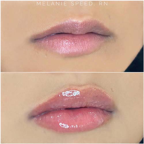 Lip Augmentation Before & After Photos by Flawless Medspa in Las Vegas NV