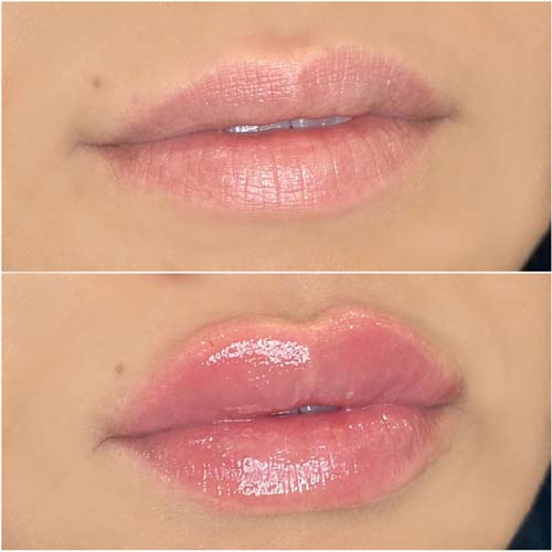 Lip Augmentation Before & After Photos by Flawless Medspa in Las Vegas NV