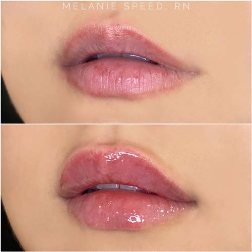 Lip Augmentation Before & After Photos by Flawless Medspa in Las Vegas NV