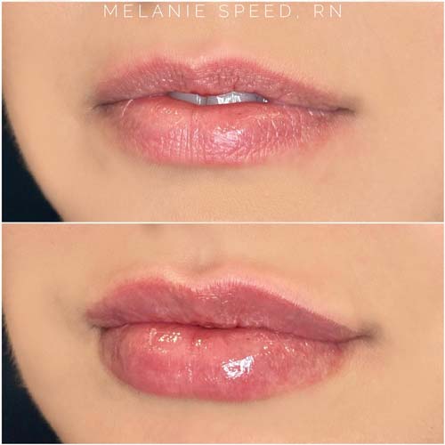 Lip Augmentation Before & After Photos by Flawless Medspa in Las Vegas NV