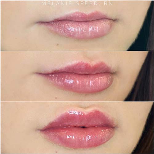 Lip Augmentation Before & After Photos by Flawless Medspa in Las Vegas NV