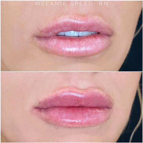 Lip Augmentation Before & After Photos by Flawless Medspa in Las Vegas NV