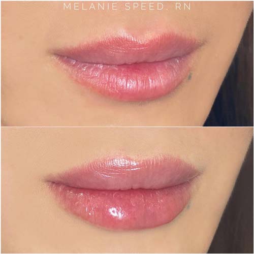 Lip Augmentation Before & After Photos by Flawless Medspa in Las Vegas NV