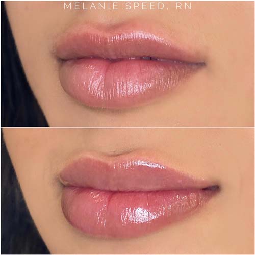 Lip Augmentation Before & After Photos by Flawless Medspa in Las Vegas NV