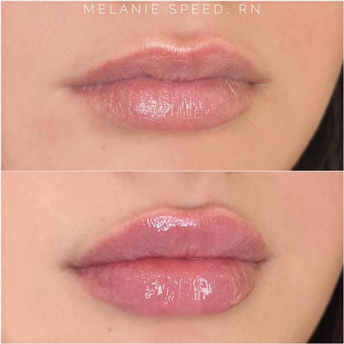 Lip Augmentation Before & After Photos by Flawless Medspa in Las Vegas NV