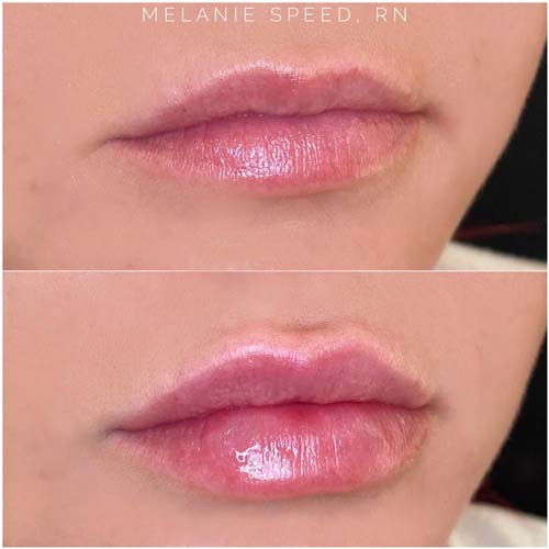 Lip Augmentation Before & After Photos by Flawless Medspa in Las Vegas NV