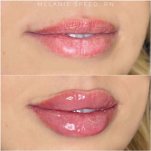 Lip Augmentation Before & After Photos by Flawless Medspa in Las Vegas NV