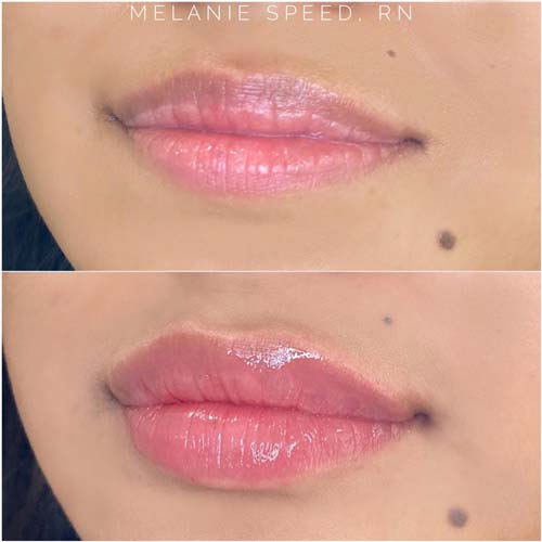 Lip Augmentation Before & After Photos by Flawless Medspa in Las Vegas NV