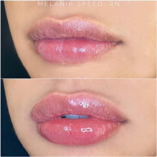 Lip Augmentation Before & After Photos by Flawless Medspa in Las Vegas NV