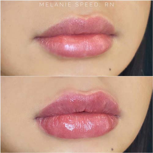 Lip Augmentation Before & After Photos by Flawless Medspa in Las Vegas NV