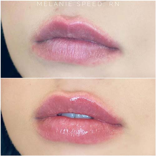 Lip Augmentation Before & After Photos by Flawless Medspa in Las Vegas NV