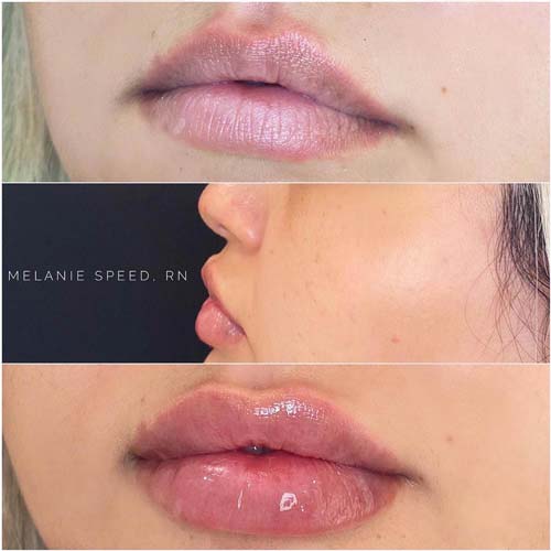 Lip Augmentation Before & After Photos by Flawless Medspa in Las Vegas NV