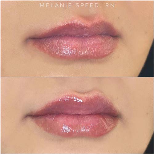 Lip Augmentation Before & After Photos by Flawless Medspa in Las Vegas NV