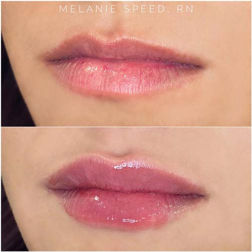 Lip Augmentation Before & After Photos by Flawless Medspa in Las Vegas NV