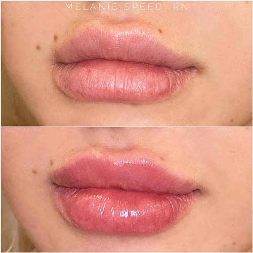 Lip Augmentation Before & After Photos by Flawless Medspa in Las Vegas NV