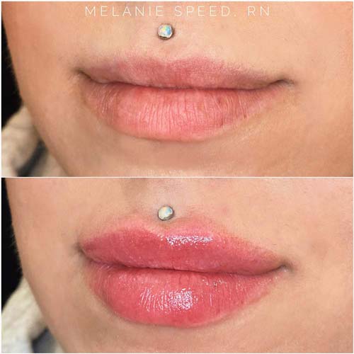 Lip Augmentation Before & After Photos by Flawless Medspa in Las Vegas NV