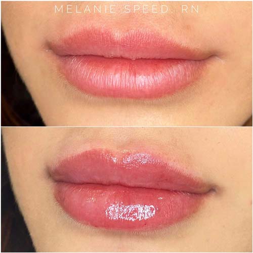 Lip Augmentation Before & After Photos by Flawless Medspa in Las Vegas NV