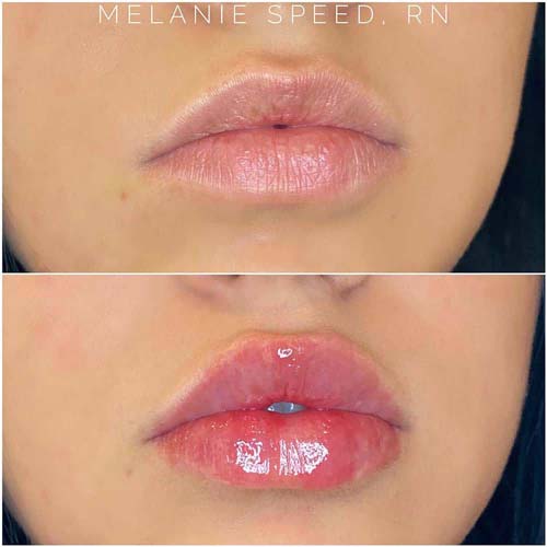 Lip Augmentation Before & After Photos by Flawless Medspa in Las Vegas NV