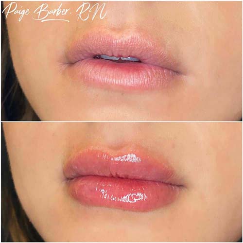 Lip Augmentation Before & After Photos by Flawless Medspa in Las Vegas NV