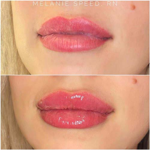 Lip Augmentation Before & After Photos by Flawless Medspa in Las Vegas NV