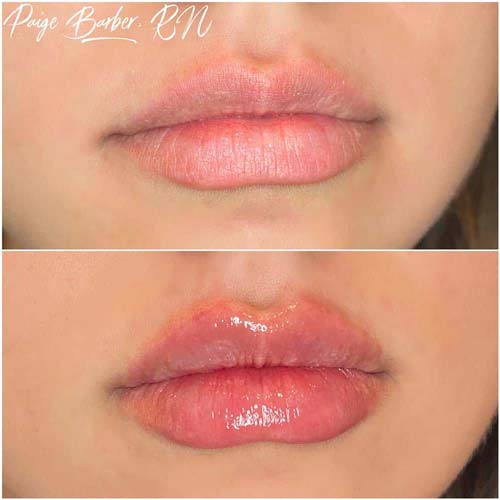 Lip Augmentation Before & After Photos by Flawless Medspa in Las Vegas NV