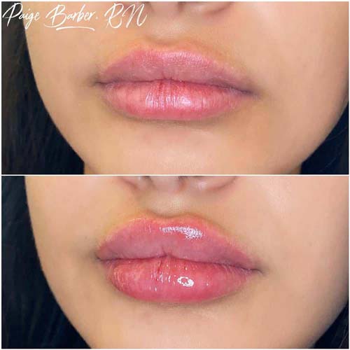 Lip Augmentation Before & After Photos by Flawless Medspa in Las Vegas NV