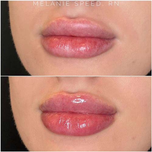 Lip Augmentation Before & After Photos by Flawless Medspa in Las Vegas NV