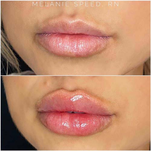 Lip Augmentation Before & After Photos by Flawless Medspa in Las Vegas NV