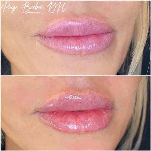 Lip Augmentation Before & After Photos by Flawless Medspa in Las Vegas NV