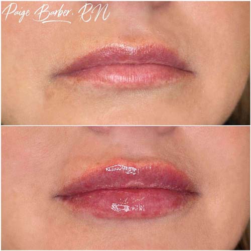 Lip Augmentation Before & After Photos by Flawless Medspa in Las Vegas NV