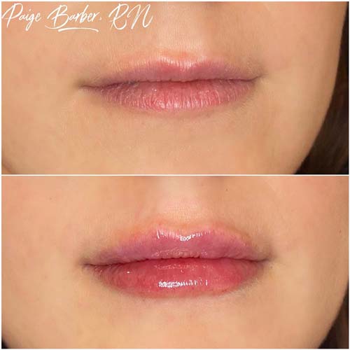 Lip Augmentation Before & After Photos by Flawless Medspa in Las Vegas NV