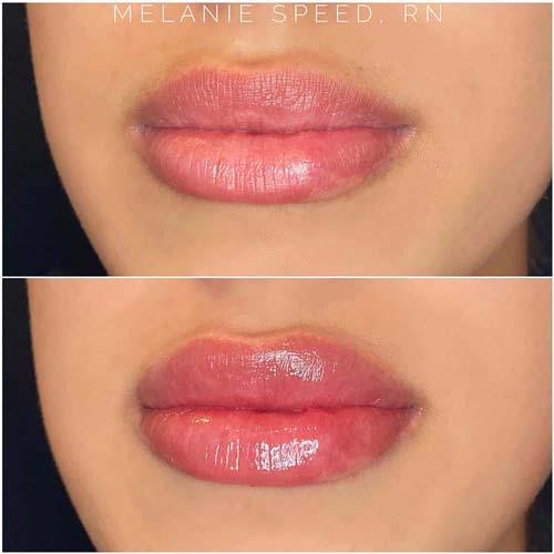 Lip Augmentation Before & After Photos by Flawless Medspa in Las Vegas NV