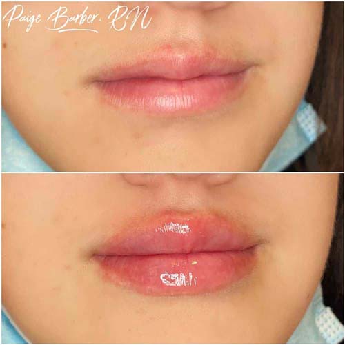 Lip Augmentation Before & After Photos by Flawless Medspa in Las Vegas NV