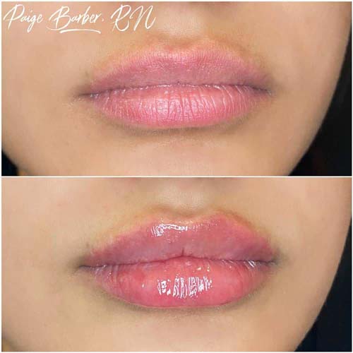 Lip Augmentation Before & After Photos by Flawless Medspa in Las Vegas NV