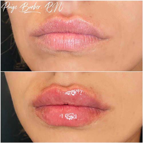 Lip Augmentation by Flawless Medspa Lip Augmentation by Flawless Medspa