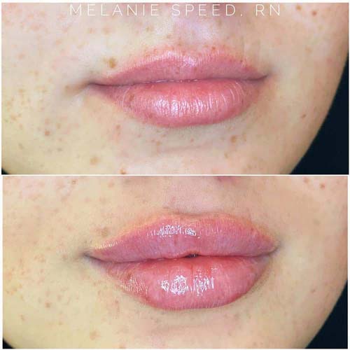 Lip Augmentation by Flawless Medspa Lip Augmentation by Flawless Medspa