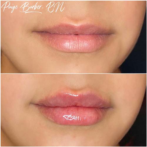 Lip Augmentation Before & After Photos by Flawless Medspa in Las Vegas NV