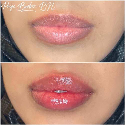 Lip Augmentation Before & After Photos by Flawless Medspa in Las Vegas NV