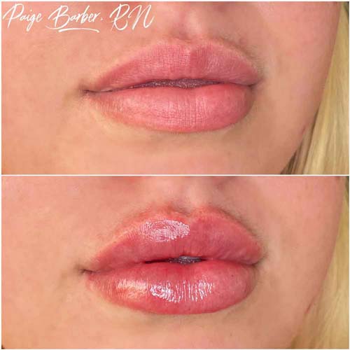 Lip Augmentation Before & After Photos by Flawless Medspa in Las Vegas NV