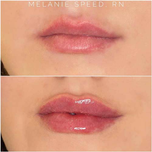 Lip Augmentation Before & After Photos by Flawless MedSpa & The Beverly Hills MedSpa in Las Vegas NV Lip Augmentation Before & After Photos by Flawless MedSpa & The Beverly Hills MedSpa in Las Vegas NV
