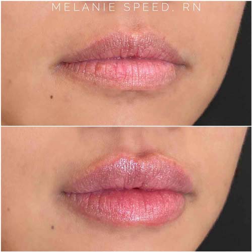 Lip Augmentation Before & After Photos by Flawless Medspa in Las Vegas NV