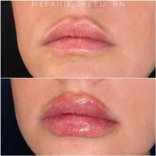 Lip Augmentation Before & After Photos by Flawless Medspa in Las Vegas NV