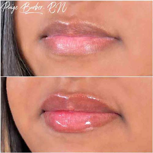 Lip Augmentation Before & After Photos by Flawless Medspa in Las Vegas NV